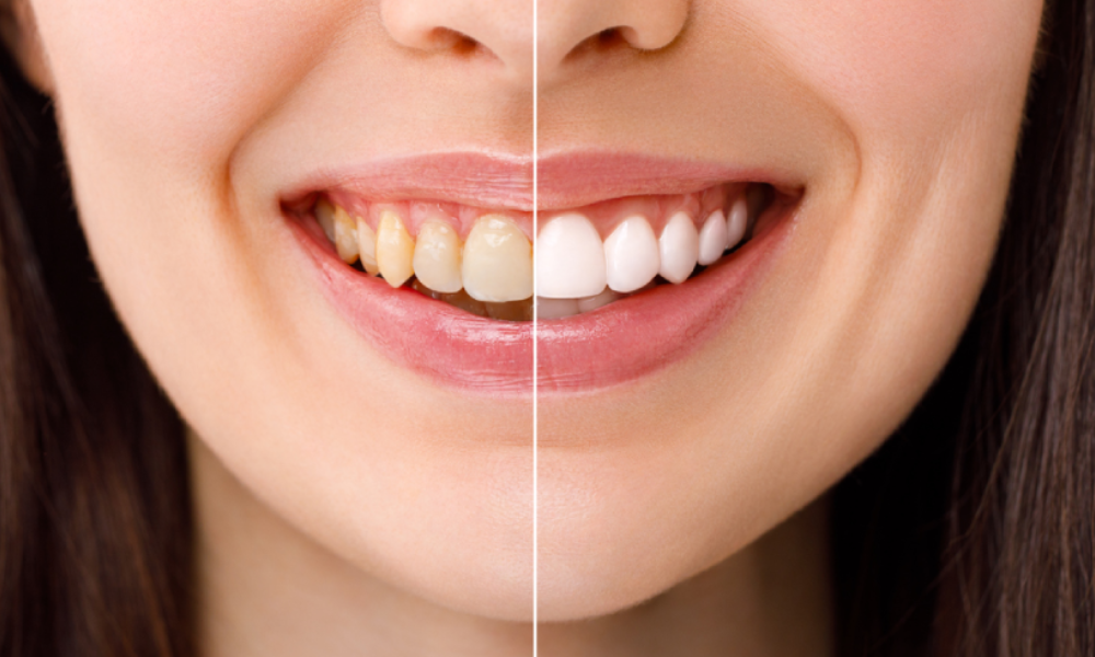 medica soins | blanchissement-dentaire-medica-soins