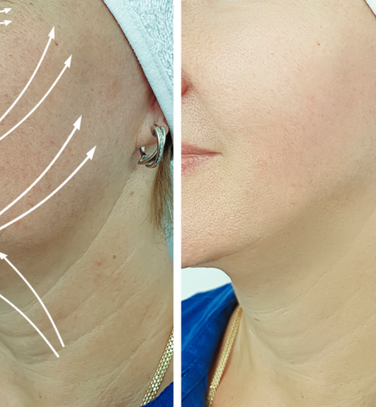 medica soins | biolifting-collagène-cou-medica-soins